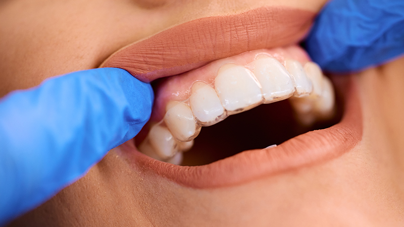 Straighten Your Teeth with ClearCorrect Invisible Braces