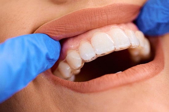 Straighten Your Teeth with ClearCorrect Invisible Braces image
