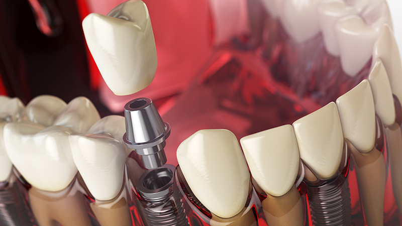 Multiple Implants