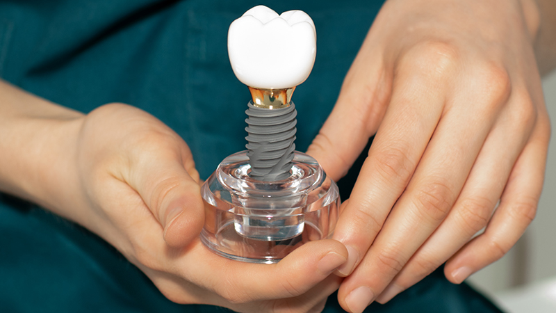 How to Care For Dental Implants So They Last Forever