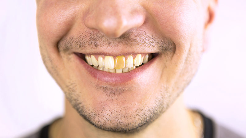 Common Causes of Tooth Discoloration