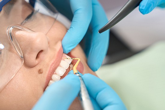 4 Benefits of Dental Crowns