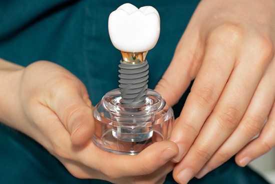 How to Care For Dental Implants So They Last Forever