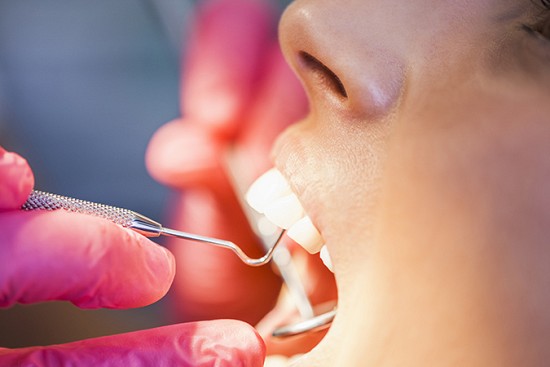 Why Do My Gums Bleed?