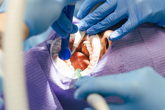 Cavities: The Most Common Dental Health Concern