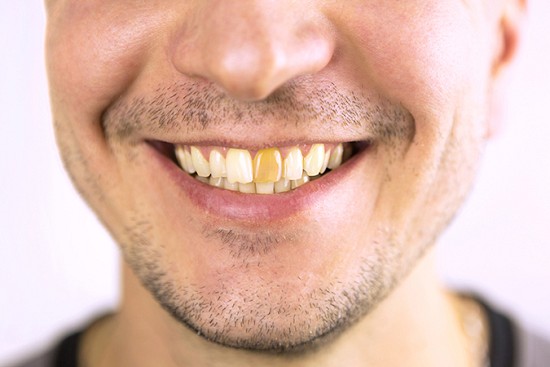 Common Causes of Tooth Discoloration